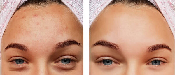 acne before and after acne before and after