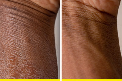 Dry-Hands-600x400(optimized) Dry hands solution