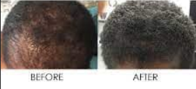 Before And After Healthy Hair Growth Before And After Healthy Hair Growth